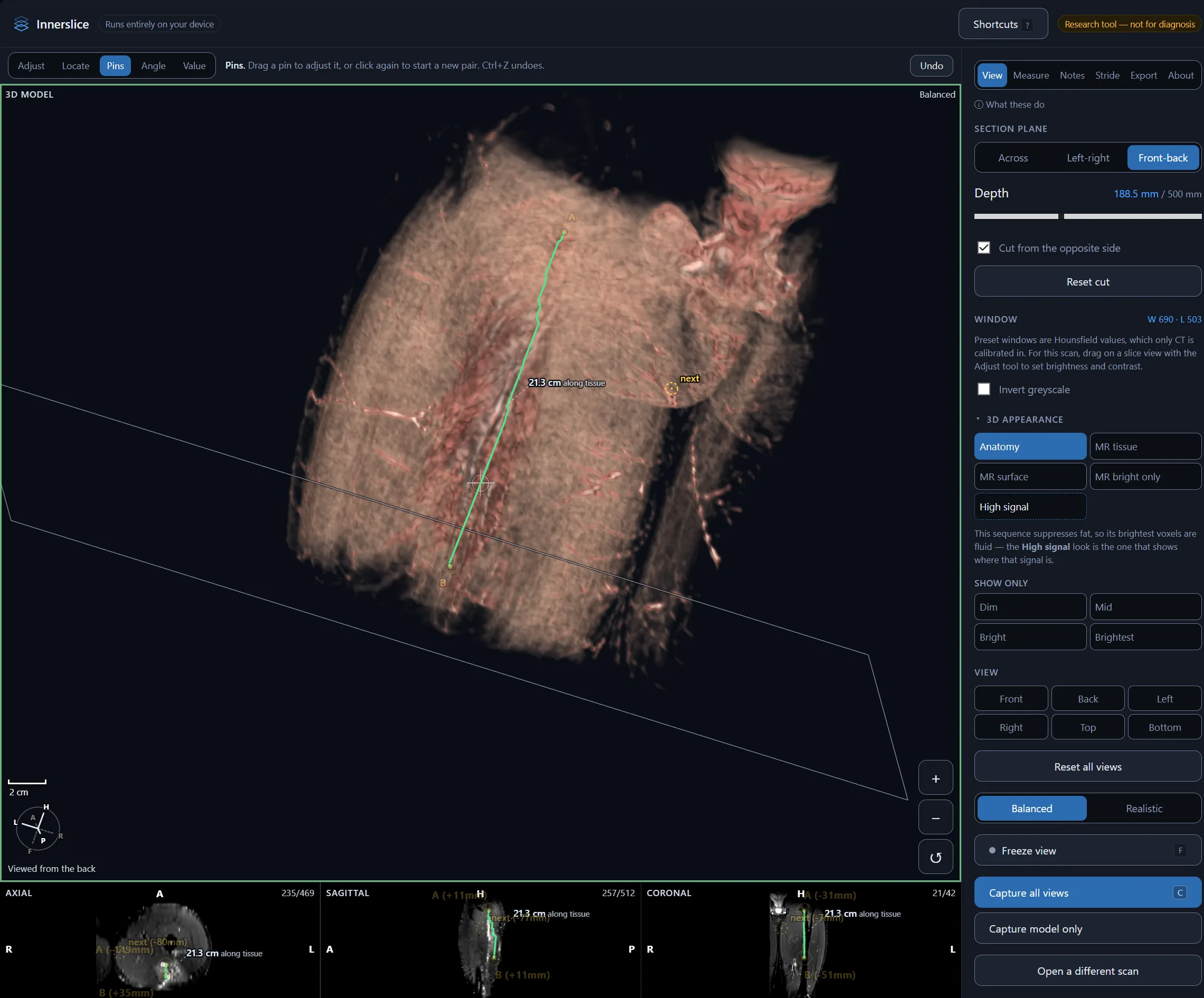 Innerslice screenshot: Measuring a 21 cm distance along tissue with pins